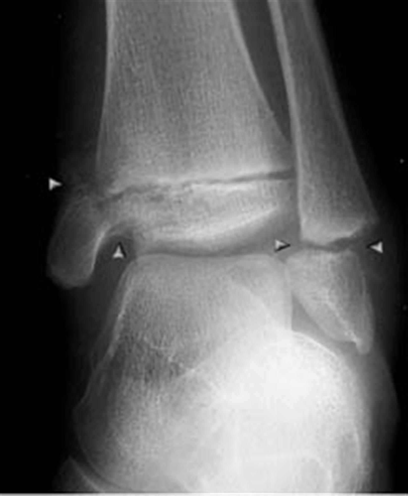 Ankle Fractures Pediatric Pediatrics Orthobullets